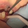 Trying to pull a broken tooth at home is especially dangerous if you don't have the proper tools. 1
