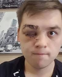 Young man left blind in one eye after attack in restaurant