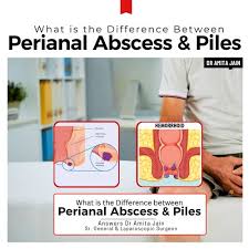 Image result for Perianal Abscess