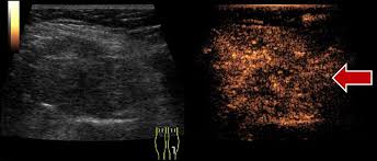 Sonografie oder sonographie, auch echografie und ultraschalluntersuchung, oder umgangssprachlich „ultraschall, genannt, ist ein bildgebendes verfahren mit anwendung von ultraschall zur untersuchung von organischem gewebe in der medizin und veterinärmedizin sowie von technischen strukturen. Compgefa Sonographie