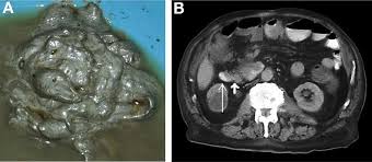 Image result for acholic stools human