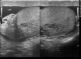 In the area of the clinically palpable lump, a bilobed anechoic cystic lesion that measured 5 cm was seen. Tubular Ectasia Of Rete Testis Radiology Reference Article Radiopaedia Org
