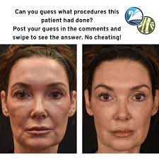 💋✨ Actual patient of our NP Ashli Davis. Enhance your natural beauty with  RHA2 lip filler! ✨💋 Achieve soft, luscious lips that look and feel  effortlessly beautiful. RHA2 is specially designed to