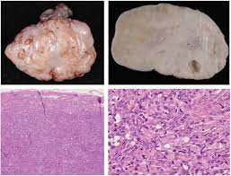 metastasis is a pathogenic agent&#x27;s spread from an initial or primary site to a different or secondary site within the host&#x27;s body; Krukenberg Tumor Wikipedia