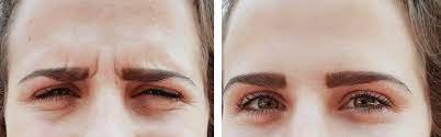 How to fix asymmetrical eyes? How To Fix Asymmetric Eyes With Botox Vida Wellness And Beauty