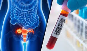 You may feel comfortable discussing your feelings with a friend or family member, or you might prefer meeting with a formal support group. Ovarian Cancer New Blood Test Could Identify Condition Early Before Symptoms Express Co Uk