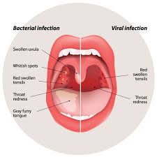 Read on for more on chronic throat pain. Sore Throat Infection Positive Parenting