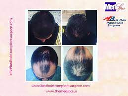 Welcomes men and women of all ages with a wide range of skin, aesthetic, cosmetic, tricology, and venereology in delhi, india. Best Hair Transplant Surgeon Delhi India Hair Transplant Doctor Choose An Experienced And H Fue Hair Transplant Hair Transplant Hair Transplant Surgery