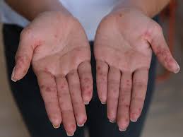 Maybe you would like to learn more about one of these? Hand Foot And Mouth Disease In Adults Symptoms And Treatment