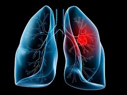Image result for Lung Cancer
