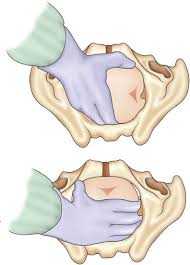 Image result for Manual Rotation in Occipitoposterior Presentation