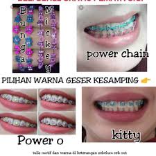 Bentuk retainer gigi berbeda dari behel. Behel Murah Harga Terbaik Agustus 2021 Shopee Indonesia