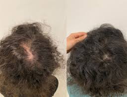 Read what dermatologists have to say before you what we know: Laser Hair Regrowth Leeds Hair Loss Treatment Clinic Leeds