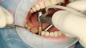 Check spelling or type a new query. Jangan Sampai Infeksi Begini Perawatan Setelah Operasi Impaksi