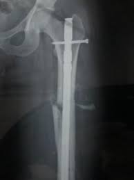 Bacak Kirilmasi Femur Kirigi