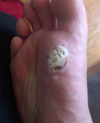 See full list on beautyanswered.com Used A Callus Remover And The Reveal Was Horrifying Trypophobia