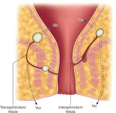 Image result for Intersphincteric Abscess