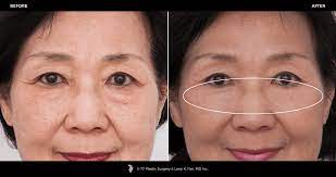 Our galleries showcase before and after plastic surgery pictures to supply you with as much insight into our previous client's results. Eyelid Surgery Brow Lift 77p Gallery 77p Gallery