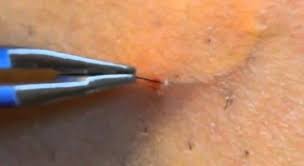 Like being summoned for jury duty or having to do taxes, getting ingrown hair is one of those sad basically what happens is, instead of growing upward and outward, an ingrown hair will curl back. Pin On Beauty