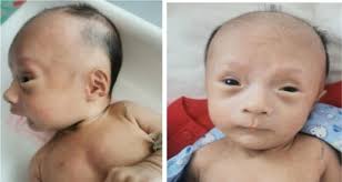 X-linked intellectual developmental disorder with onset of neonatal heart  failure: A case report and literature review