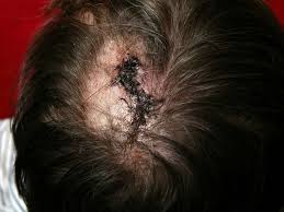 Scabs And Sores On The Scalp Can Be Painful And Itchy But They Often Clear Up O Sores On Scalp Scarring Alopecia Scalp Conditions