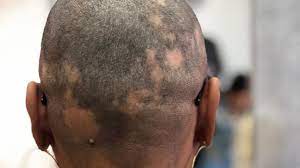 This is seen especially the side where hair are pulled tightly. Alopecia Areata Causes Symptoms And Diagnosis