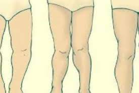 تقوس الساقين عند الرضع تعرفي على الاسباب والعلاج مجلة الجميلة