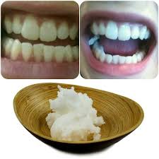Before And After Two Days 4 Times Oil Pulling With Coconut Oil I Cannot Believe What It S Coconut Oil For Teeth Coconut Oil Pulling Coconut Oil Pulling Teeth