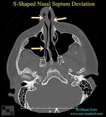 Septum is the latin word for wall and the nasal septum is the wall that divides the right side of the nasal cavity from the left. Nasal Septum Deviation Symptoms Diagnosis And Treatment