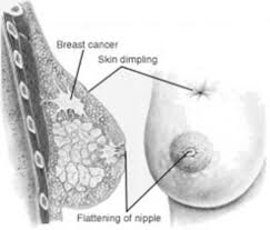 Breast cancer spreads when the cancer grows into other parts of the body through the blood vessels and lymph vessels. The Breast Clinical Gate