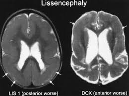Hypoplasia of pons & cerebellum. Lissencephaly Type 2