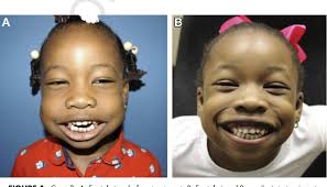 Figure 1 from A Paradigm Shift in the Management of Cherubism? A  Preliminary Report Using Imatinib.