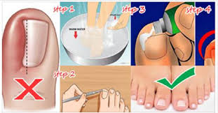 home remedy for ingrown toenails