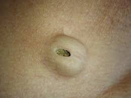 Pilar cysts and lipomas may form on the scalp, but are typically localized masses that do not cause uniform changes to the entire scalp. Epidermal Inclusion Cyst Article
