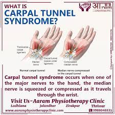 People with this condition may feel pain, numbness. Carpal Tunnel Syndrome Cts Definition Symptoms Causes Exercises