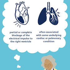 Pacemakers provide electrical stimuli to cause cardiac contraction, pacing systems consist of a pulse generator and pacing leads. Overview Of Right Bundle Branch Block Rbbb