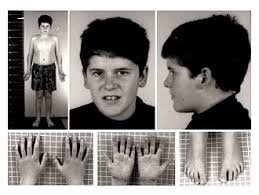 Check spelling or type a new query. Prader Willi Syndrome Wikipedia