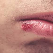 The other person is you look like a classic case of balantis most likely caused by fungal/yeast. Herpes Simplex Virus Oral And Genital Herpes Poz