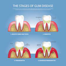 How To Stop The Progression Of Gum Disease | Dentist Denver & Lone Tree