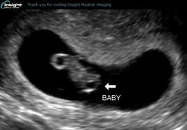 What to expect at your first ultrasound. First Ultrasound January 2020 Birth Club Babycenter Canada