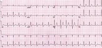 Seorang pria berusia 50 tahun datang dengan ke ugd dengan keluhan nyeri dada sebelah kiri seperi tertindih beban sifatnya menjalar sampai lengan,riwayat. Ecg Ekg Bundle Branch Block Oxford Medical Education