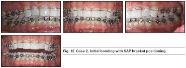 Bracket Positioning For Smile Arc Protection Jco Online