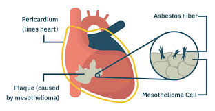 Mesothelioma often has a poor prognosis. Mesothelioma Pictures Mesothelioma Com