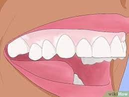 How To Treat White Gums Your Top Questions Answered