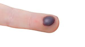 Dermaga malam saya ingin bertanya bagaimana untuk menghilangkan darah beku pada jari kaki terima kasih kepada dokumen. Pin Di Kesehatan