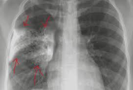 Image result for Pneumonia