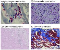 Image result for Myocarditis