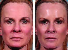 Dec 31, 2020 · a very short pixie cut may suit you, but it can show off your double chins. A Preoperative View Of This 55 Year Old Woman With Submental And Jowl Download Scientific Diagram