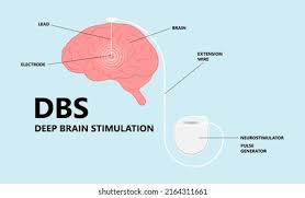 Image result for Pallidotomy
