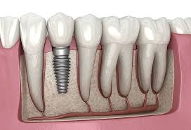 Award winning medical aesthetics group. Dental Implant Wikipedia